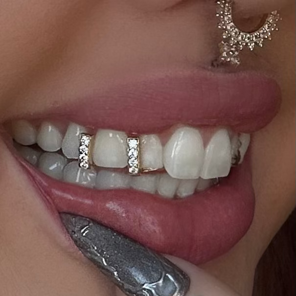 moissanite gap filler double cap portland oregon Custom solid gold grillz for sale, luxury dental jewelry available for online order and Portland Oregon clients